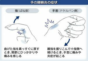 腱鞘炎（ばね指、ド・ケルバン病）