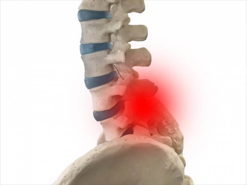 腰の骨がズレて神経を圧迫している状態を示す腰椎模型画像