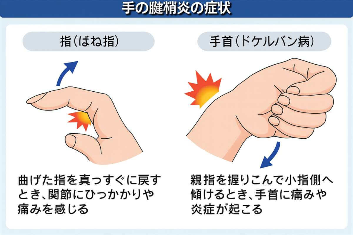 ばね指とドケルバン病の違いを図解したイラスト。炎症や痛みの出る動きと部位を説明してい